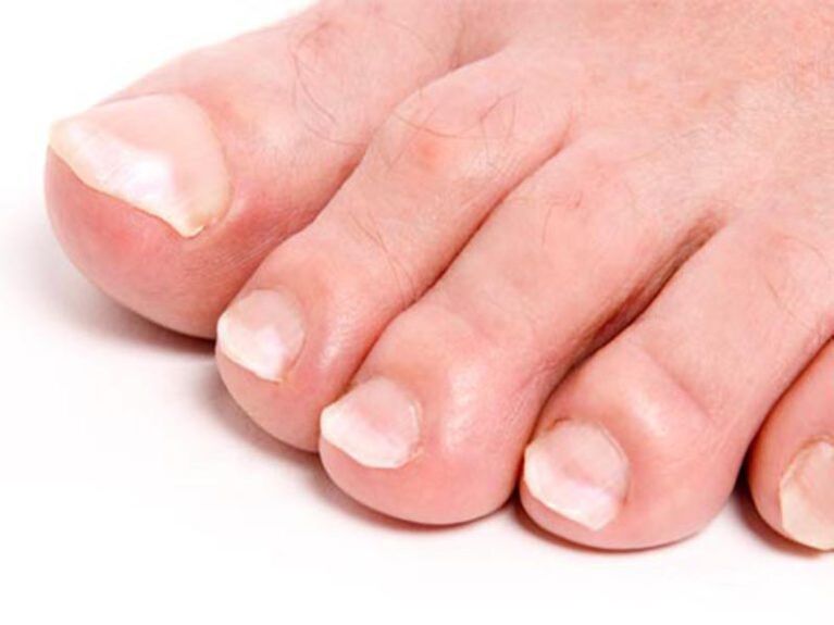 toenail fungus and their treatment
