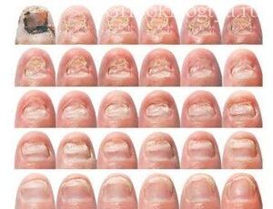 Gradual damage to nails with fungi