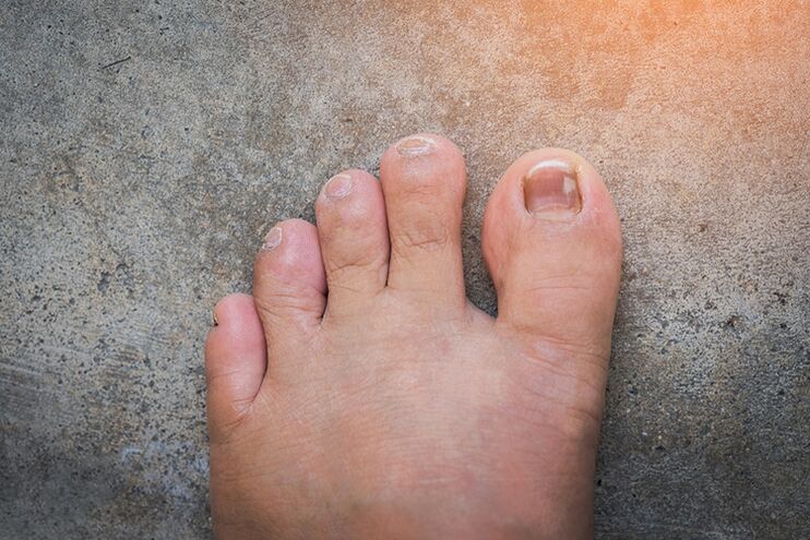 Fungus nail