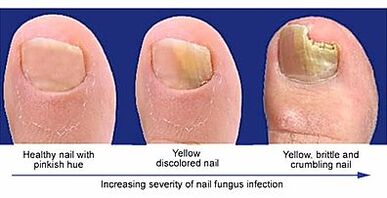 Manifestation Fungus Nail