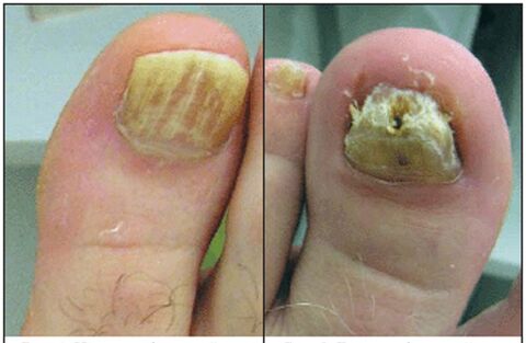 Noretatrophic type of fungus