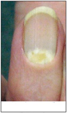 Proximal fungal deformation