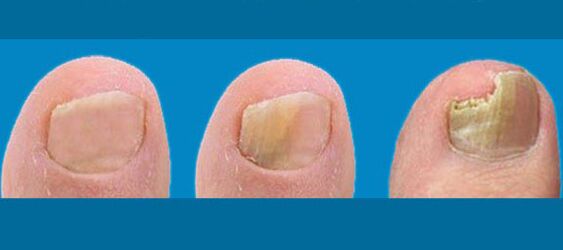 Phase Fungus Nails