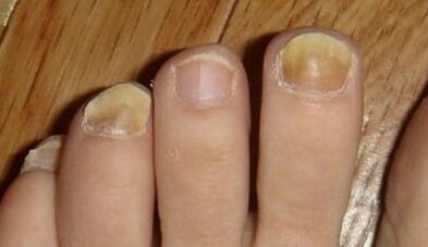 Causes appear to be fungus on nails