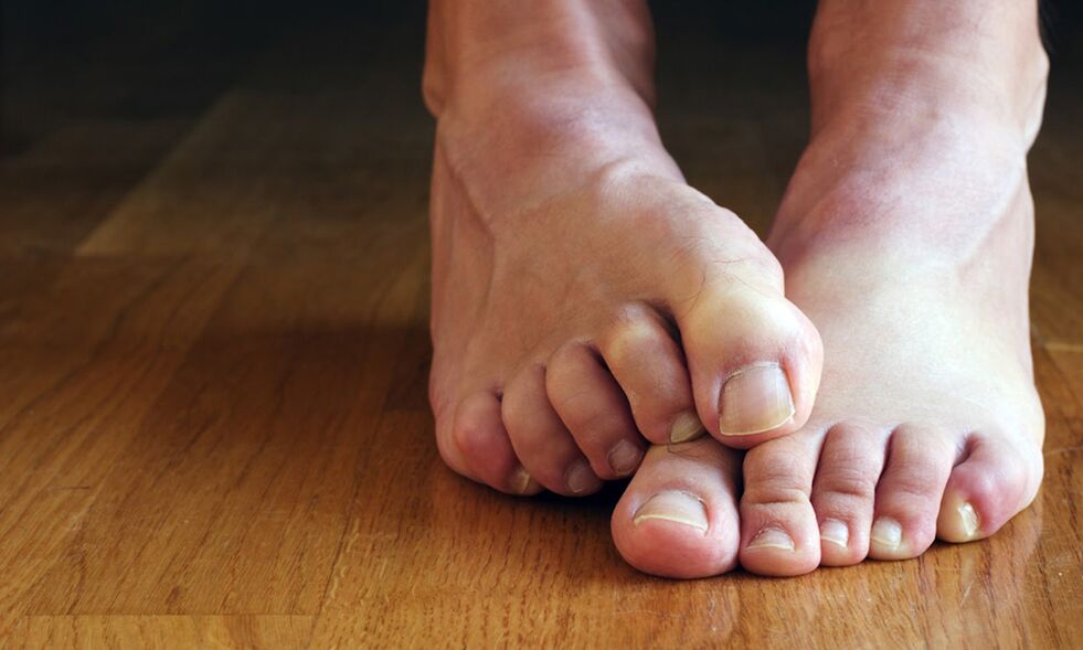 fungus that itches on toenails