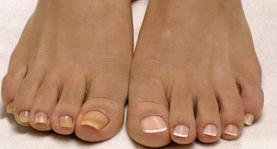 Normal nails and fungus nails