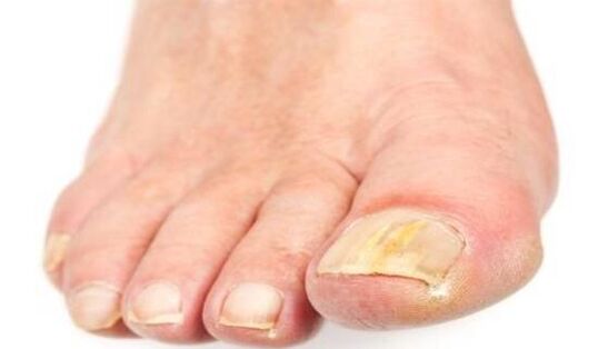 Yellow nails due to fungal infection