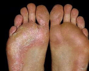 fungal foot lesion