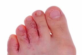 skin lesions due to foot fungus