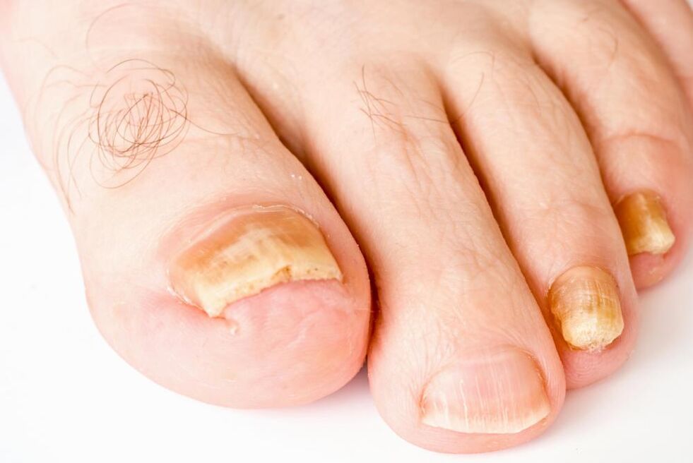 nail fungus symptoms