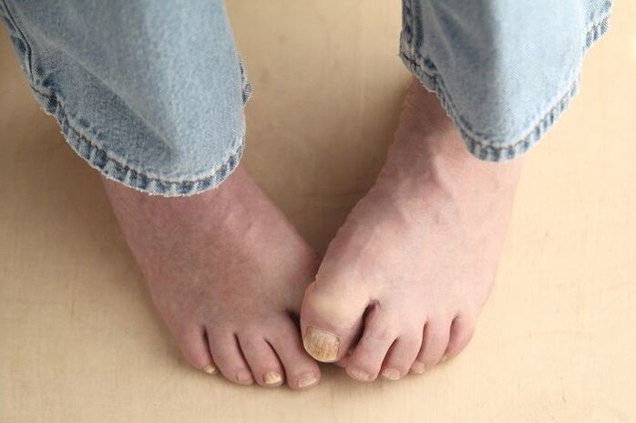 Feet with nails affected by fungus