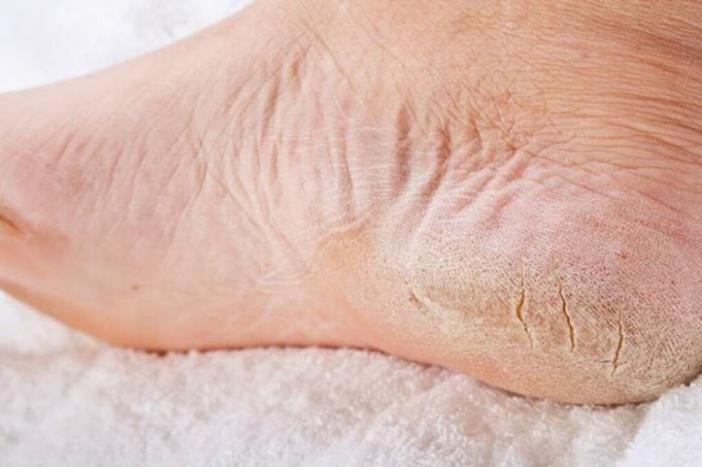 Cracked heels are a sign of foot fungus