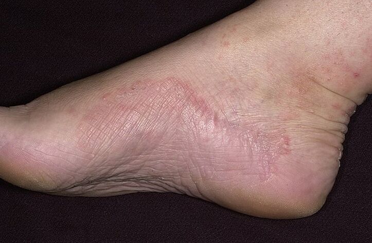 Fungal infection of the feet