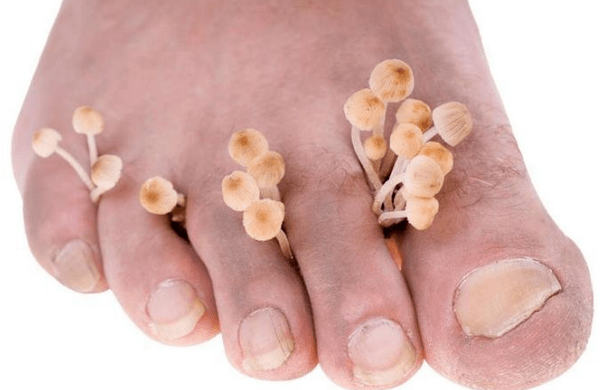 Fungal infection of the feet