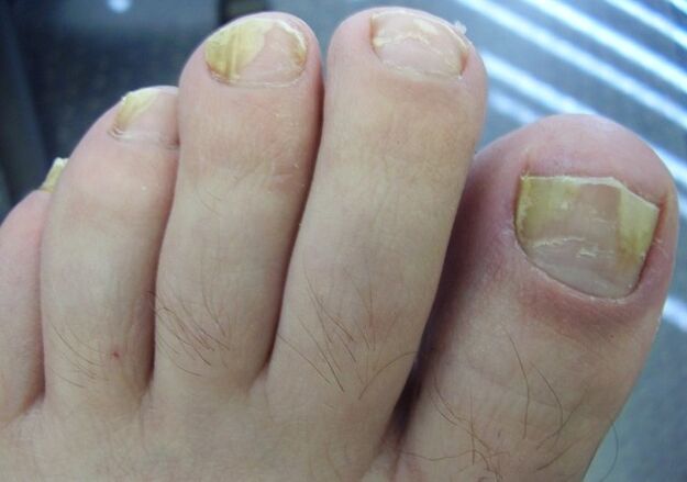 Toenails affected by fungus